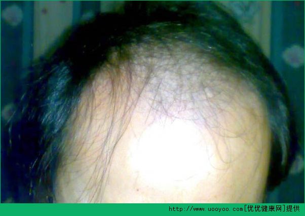 男性脫發(fā)是腎虛嗎？男性脫發(fā)與腎有何關(guān)聯(lián)？(4)