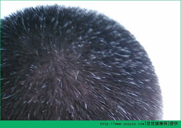 15歲為什么會有白頭發(fā)？15歲為什么會長白頭發(fā)？(2)