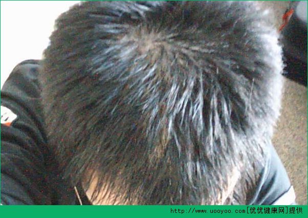 預(yù)防脫發(fā)的方法有哪些？預(yù)防脫發(fā)有哪些妙招？(1)