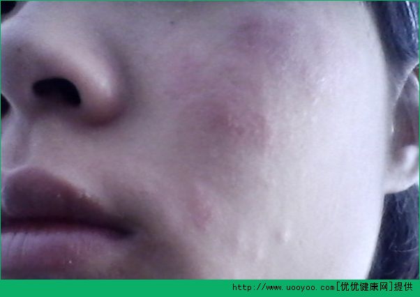 春天臉上過敏怎么辦？春天臉上過敏起小疙瘩怎么治療？(1)