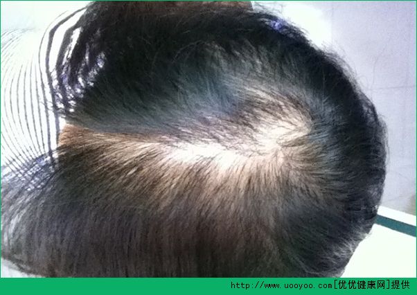 脂溢性脫發(fā)能治好嗎？脂溢性脫發(fā)如何治？(1)