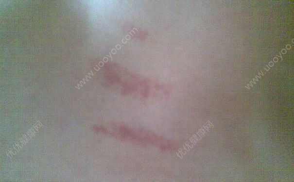 吻痕是什么意思？吻痕是怎么弄出來的？(1)