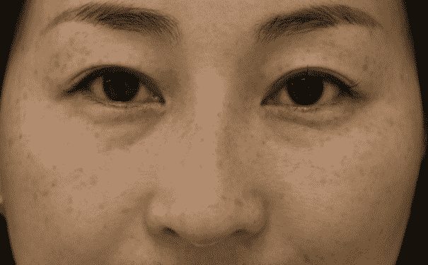 如何去除臉上的黃褐斑？去除臉上黃褐斑的方法有哪些？(1)