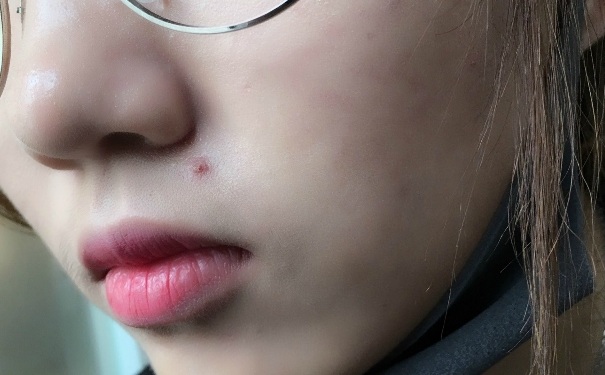刮痧可以治療痘痘嗎？刮痧刮哪里祛痘？(1)