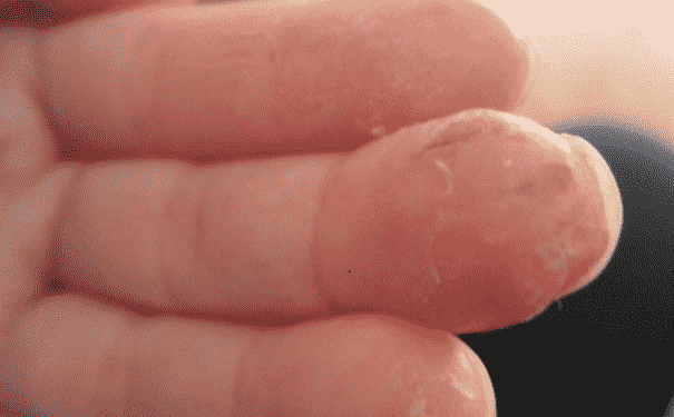 手上脫皮是怎么辦？手上脫皮的解決辦法有哪些？(1)