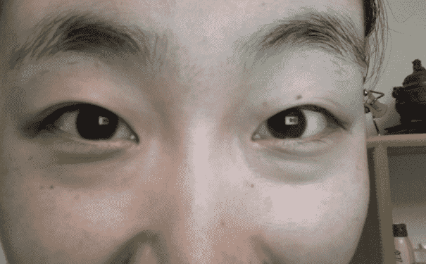 女人如何去除眼袋？女人去除眼袋的妙招有哪些？(1)