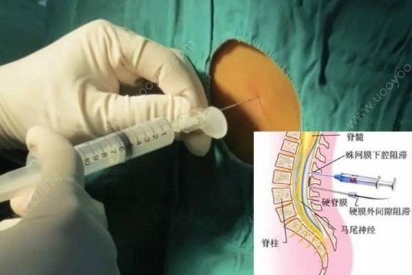 無痛分娩會(huì)影響孩子嗎？無痛分娩有哪些注意事項(xiàng)？(2)