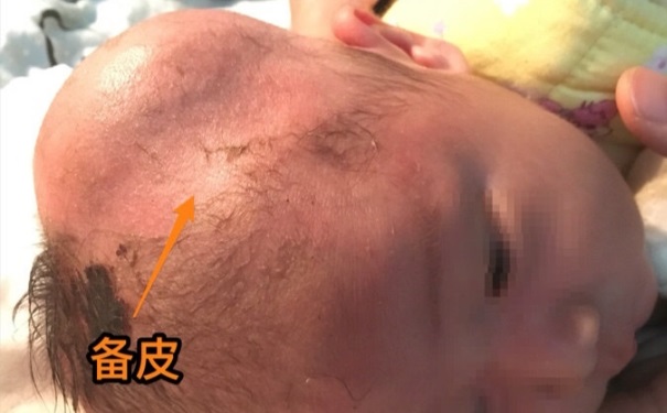 嬰兒腦血腫有后遺癥嗎？嬰兒腦血腫該怎么辦？(1)
