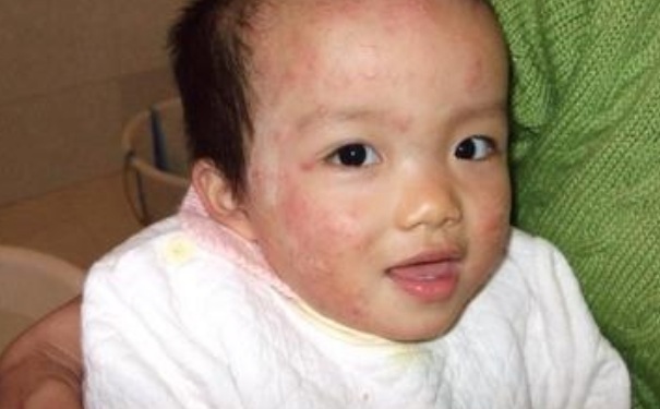 寶寶過敏有什么癥狀？六大容易被忽視的過敏癥狀？(1)