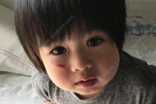 林志穎兒子跌傷臉，跌傷后如何處理？(1)