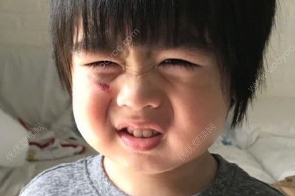 林志穎兒子跌傷臉，跌傷后如何處理？(2)