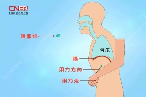 親戚喂了一?；ㄉ鷮?dǎo)致嬰兒肺氣腫，應(yīng)急急救方法須知道！(3)