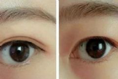 智慧型雙眼皮手術(shù)好不好？什么是智慧型雙眼皮？[圖]