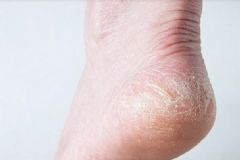 腳底干裂起硬皮是什么原因？腳底干裂起硬皮怎么辦？[圖]