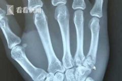 小伙看世界杯太激動直拍桌子，手被拍骨折[多圖]