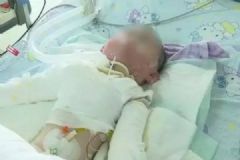 1歲半女孩掉進(jìn)湯鍋燙傷嚴(yán)重，被燙傷要注意什么？[多圖]