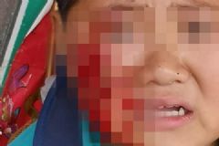 惡犬發(fā)瘋接連咬人，男孩上學(xué)路上臉頰被咬出大洞[多圖]