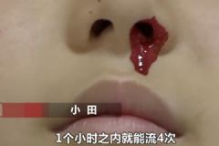 一學(xué)習(xí)就流鼻血！12歲男孩一天流20多次無(wú)奈休學(xué)！[多圖]
