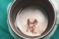 男子突發(fā)臉僵走不穩(wěn)，醫(yī)生從其腦干活捉30厘米長寄生蟲[多圖]