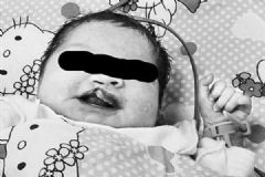 唇腭裂女嬰被棄海防林，如何預(yù)防胎兒嘴唇畸形？[多圖]