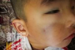 高空墜棍3歲男童被當(dāng)場砸暈，臉部現(xiàn)5厘米淤青[多圖]