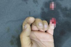6歲男孩被夾斷手指，罪魁禍首竟是校服，手指斷了如何急救？[多圖]