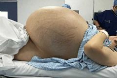 女子肚子越來(lái)越大,忽然疼痛難忍,結(jié)果取出的東西讓醫(yī)生難以相信！[多圖]