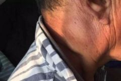 男子耳后長小疙瘩不在意，半年后變癌癥，皮下腫塊需警惕[多圖]
