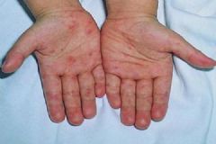 成年人也會得手足口病嗎？成年人得手足口病怎么回事？[多圖]