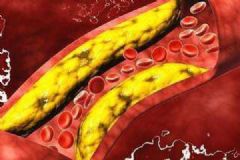 7個(gè)癥狀說明血管堵塞！如何讓血液流通順暢？[多圖]