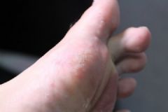 冬天有腳氣是怎么回事？治療腳氣有什么偏方？[多圖]
