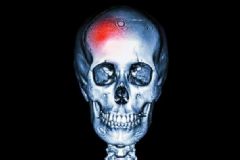 腦血管有何癥狀？腦血管有何危害？[圖]