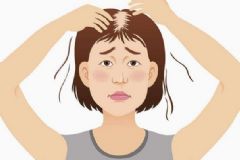 脫發(fā)應(yīng)該怎樣治療？女性脫發(fā)有何危害？[圖]
