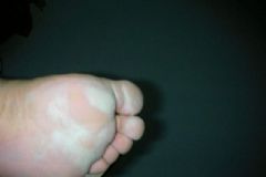 腳底脫皮有何原因？腳底脫要皮怎么辦？[圖]