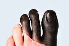 腳趾生凍瘡該怎么辦？腳趾生凍瘡怎么緩解？[多圖]
