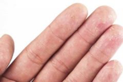 手癬患者的防治方法有那哪些？中醫(yī)治療手癬的6個偏方[圖]
