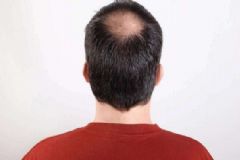 男性脫發(fā)有何原因？男性脫發(fā)怎么預(yù)防？[圖]