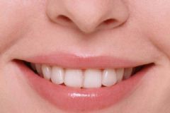 唇炎要怎么治愈？唇炎該吃什么食物？[圖]