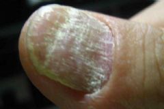 灰指甲要如何治療？灰指甲的病因有哪些？[圖]