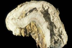 什么運(yùn)動(dòng)能預(yù)防胃癌？胃癌檢查方法有哪些？[圖]