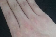 皮膚白斑該注意什么？皮膚白斑是何原因？[圖]