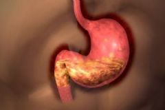 胃癌前病變是什么意思？胃癌患者生活中要注意什么？[圖]