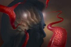 腦血栓要如何護(hù)理？腦血栓有哪些藥可治？[圖]