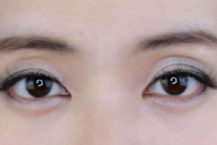 眼睛腫的原因是什么？眼睛腫了如何處理？[圖]