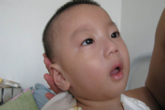 病毒性腦炎的預(yù)防方法有哪些？如何預(yù)防病毒性腦膜炎-？[圖]