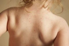 皮膚過(guò)敏治療方法都有哪些？皮膚過(guò)敏有什么治療方法？[圖]