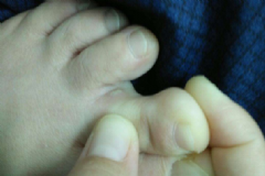 小孩有腳氣要注意什么？腳氣的注意事項(xiàng)有哪些？[圖]