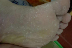 腳裂口怎么辦？腳裂口疼的走不動路怎么辦？[圖]