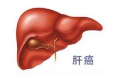 原發(fā)性肝癌病人吃什么好？肝癌患者早期的癥狀是怎樣的？[圖]