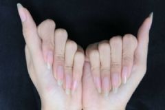 患上灰指甲應該怎樣食療？灰指甲的患病原因是什么？[圖]